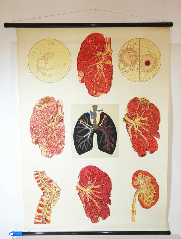 Vintage Rollkarte Tuberkulose Lunge Medizin Lehrkarte Wandtafel Deko