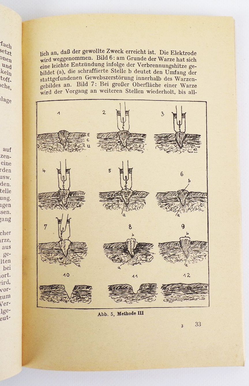 Der Hochfrequenz Strahlapparat Sein Wesen und seine Anwendung Buch Der Hochfrequenz Strahlapparat Sein Wesen und seine Anwendung Buch